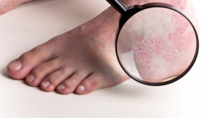 Psoriazisul nu este contagios