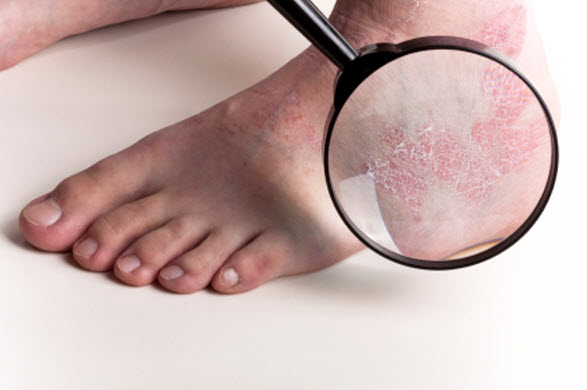 Psoriazisul nu este contagios