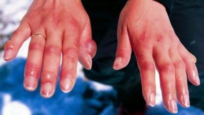 Atenţie la degerături: soluţii simple de ameliorare , la îndemâna tuturor