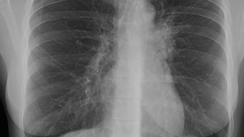 Campanie pentru controlul tuberculozei