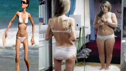 Anorexia este ereditară, de cele mai multe ori