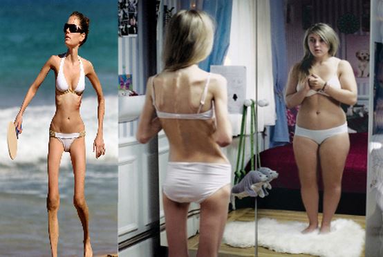 Anorexia este ereditară, de cele mai multe ori