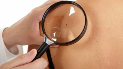 Românii merg rar la dermatolog. Când să ne îngrijoreze aluniţele?