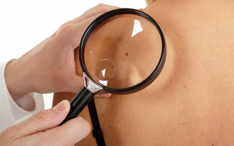 Românii merg rar la dermatolog. Când să ne îngrijoreze aluniţele?