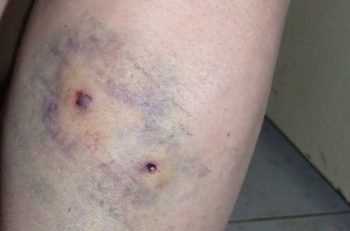 Femeie mușcată de un ciobănesc caucazian la Cernavodă