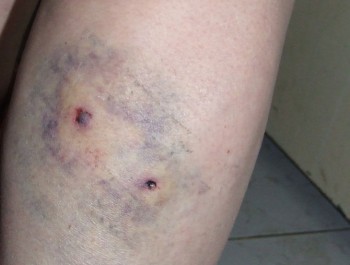 Femeie mușcată de un ciobănesc caucazian la Cernavodă