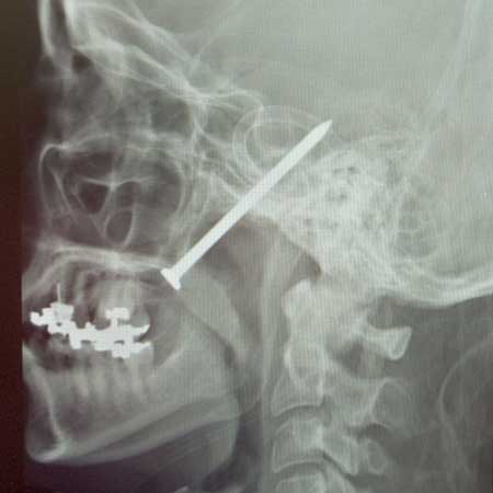 Bizar: Bărbat împușcat în cap cu un pistol cu cuie