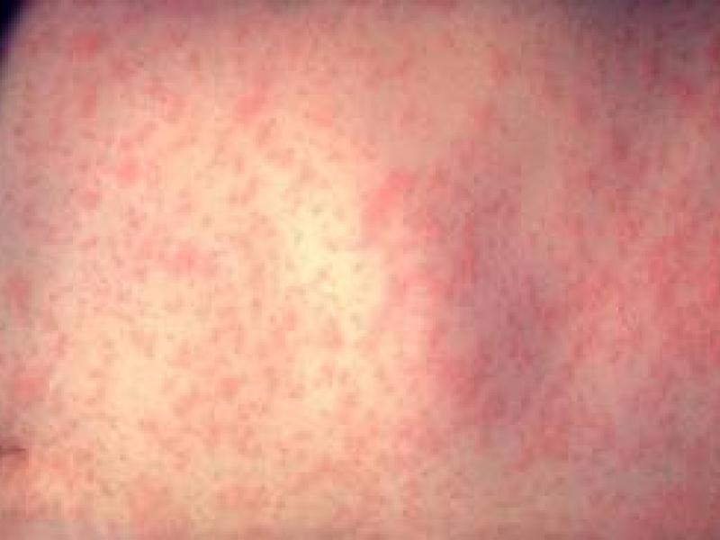 Ministerul Sănătăţii:Campania de vaccinare împotriva rubeolei trebuie urgentată