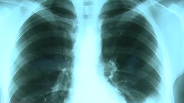 Medicament care tratează tuberculoza la copii