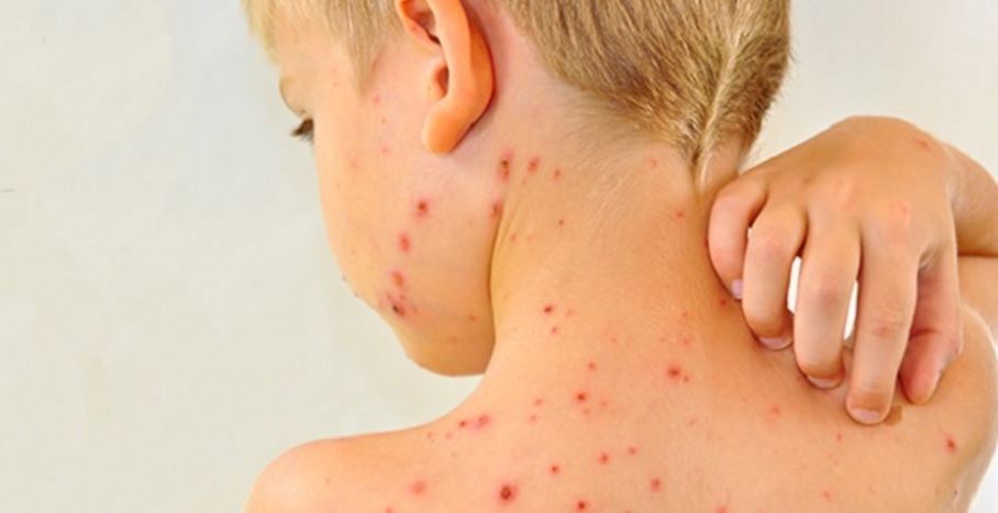 Este EPIDEMIE de RUJEOLĂ în România