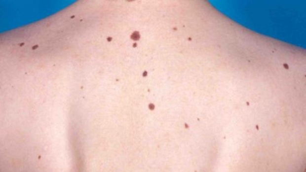 Plan de diagnosticare precoce a cancerului de piele