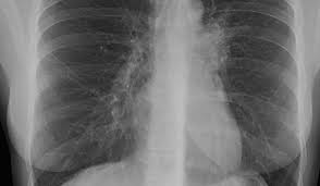 Alertă la GALAȚI: Profesoară diagnosticată cu TBC!