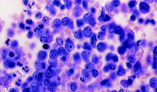 Două mutații genetice din trei, responsabile de apariţia cancerului, sunt rezultatul unor erori naturale!