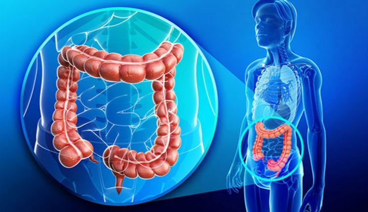 În România incidenţa cancerului colorectal a crescut de trei ori în ultimii 20 de ani