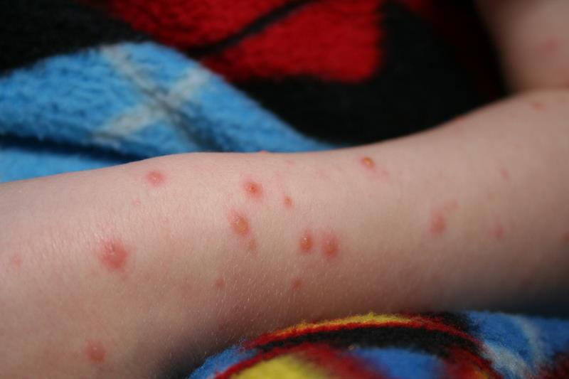 Lipsa vaccinării provoacă o TRAGEDIE națională: 21 de morți din cauza rujeolei