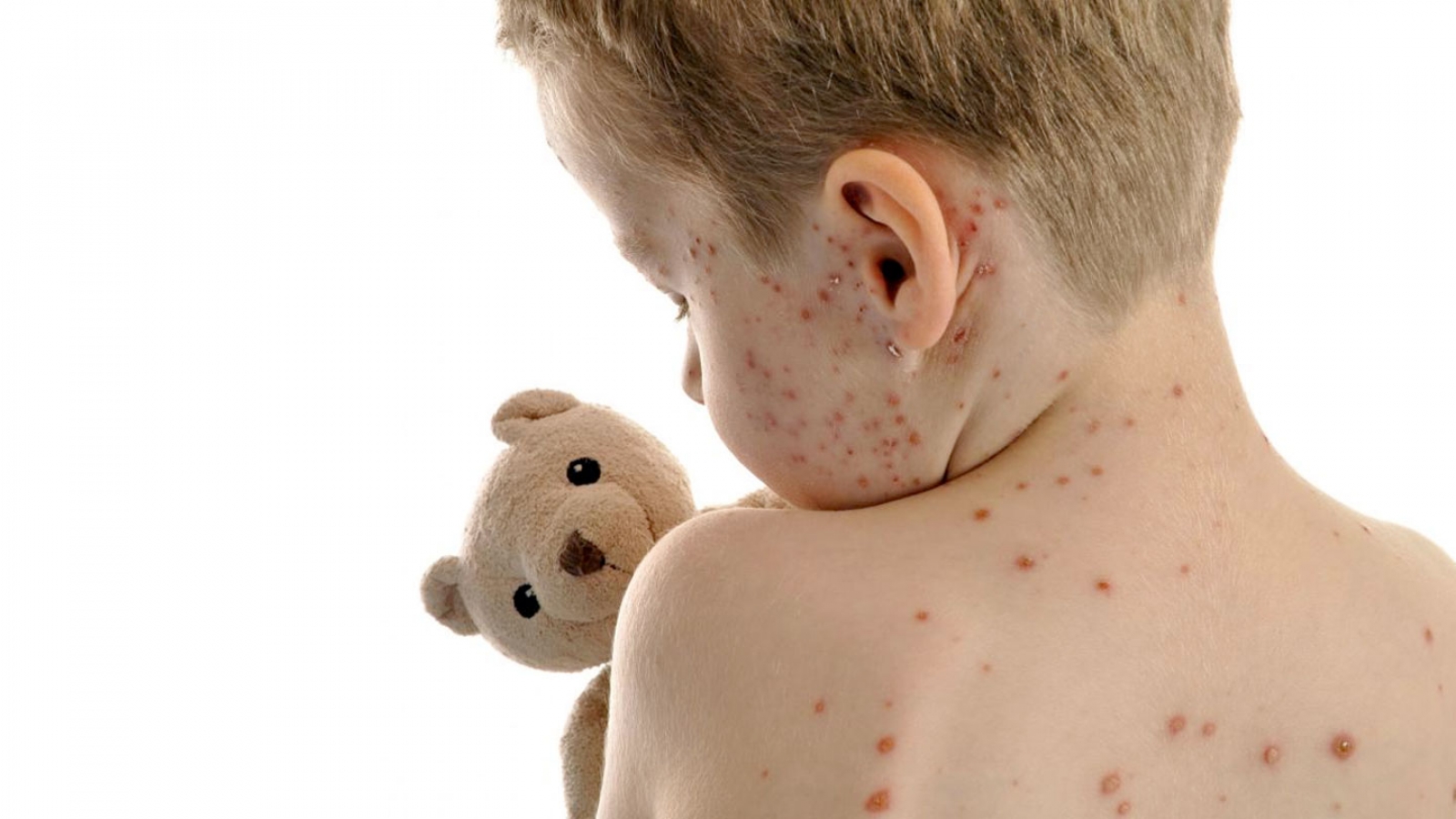 CONSTANȚA: Zeci de noi cazuri pe zi. Varicela şi scarlatina la copii – o adevărată epidemie
