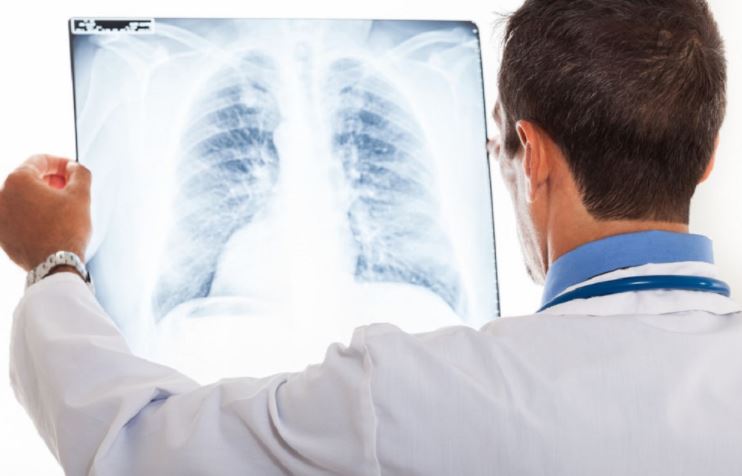 Pericolul pe care îl reprezintă depistarea tardivă a cancerului pulmonar. Bolnavii au dreptul la terapii inovatoare