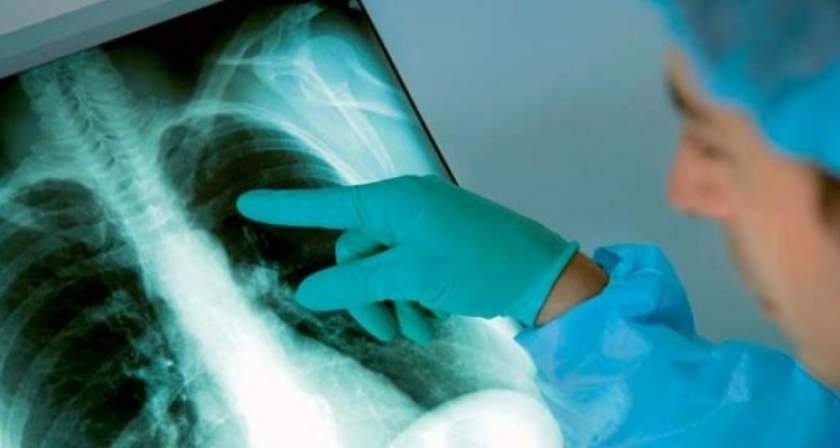 Bolnavii de TBC vor avea concediu şi indemnizaţie până la vindecare