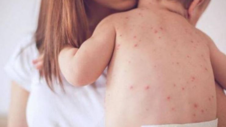 825 de cazuri noi de rujeolă înregistrate în ultima săptămână; un deces