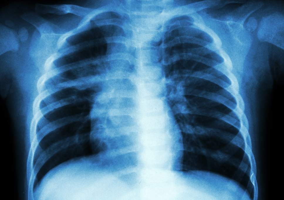24 martie – Ziua mondială de luptă împotriva tuberculozei