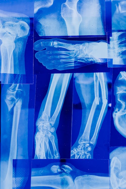 Ziua Mondială a Osteoporozei | Cea mai frecventă boală metabolică osoasă – ”boala tăcută”care rămâne deseori nedepistată