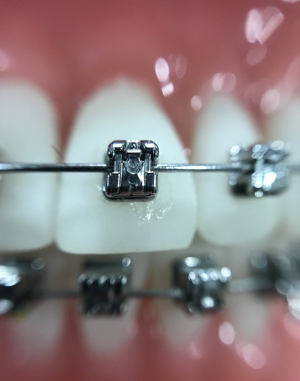 AUDIO | Igiena dentară deficitară și vizita târzie la ortodont pot știrbi zâmbetele copiilor