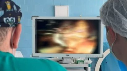 Premieră medicală la Galați: Rinichi îndepărat prin intervenție laparoscopică