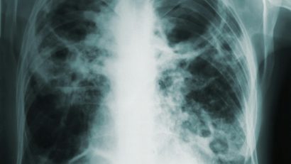 24 martie – Ziua mondială de luptă împotriva tuberculozei (OMS)